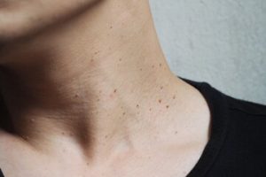Skin Tag Removal